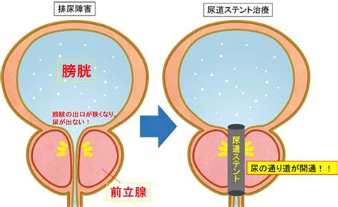 尿道プラグとは|男性における尿道カテーテル挿入